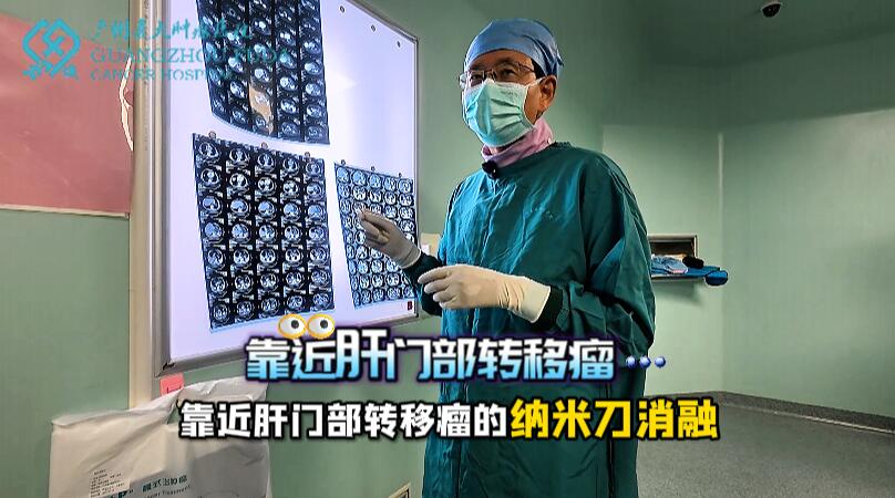 國產納米刀消融設備在胰腺癌臨床上的應用